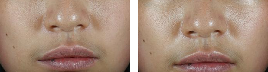 Resultados do tratamento na face